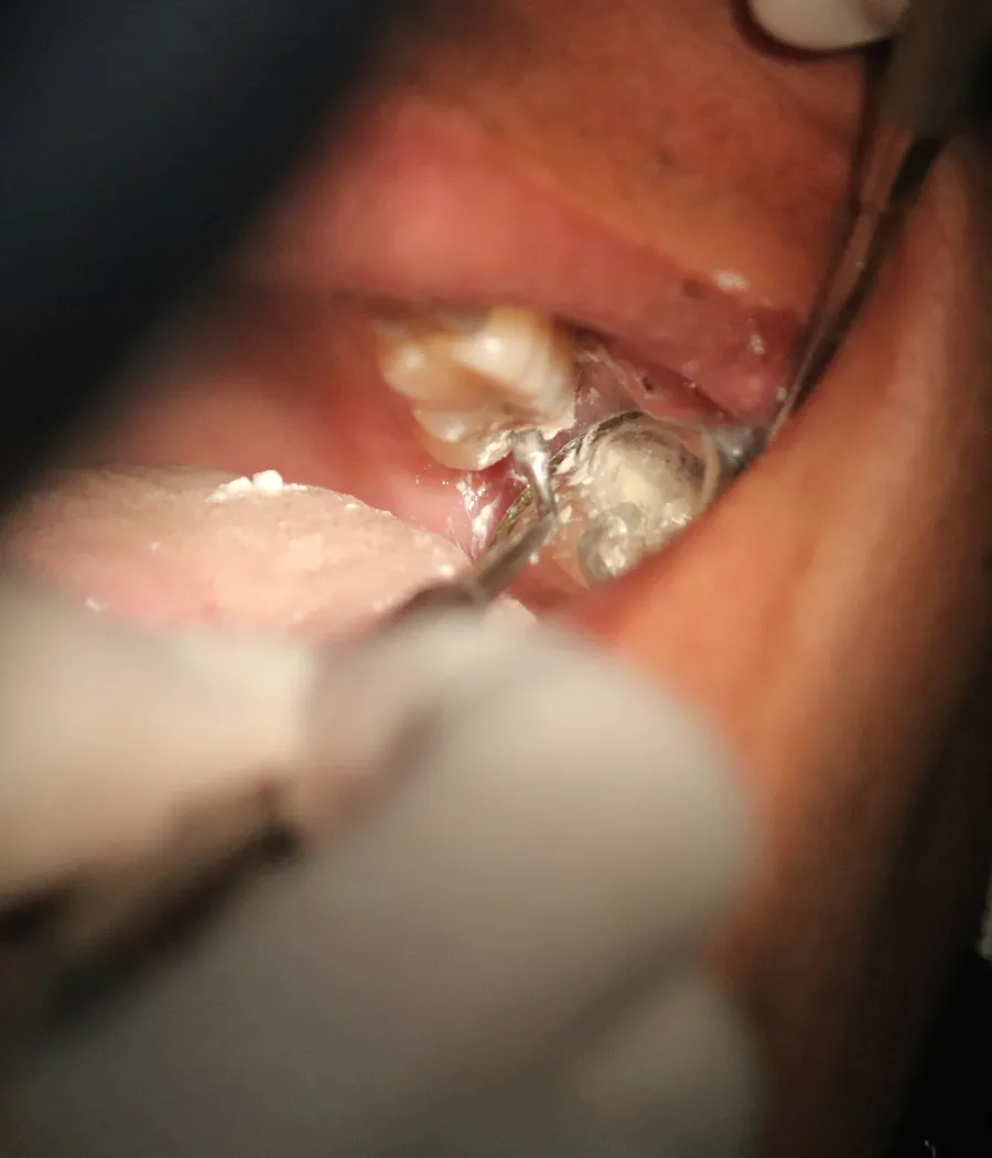 Close clinical view of a tooth extraction in progress