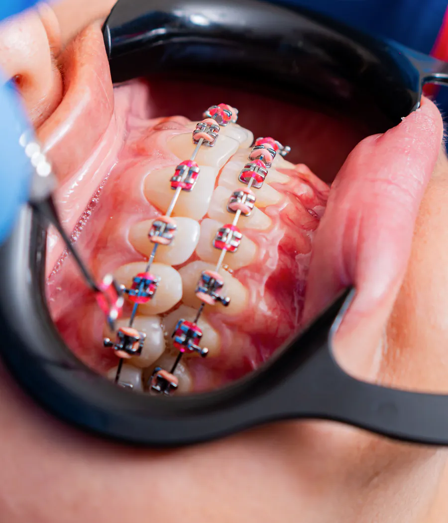 Close intraoral view of teeth fitted with metal braces and coloured ligatures