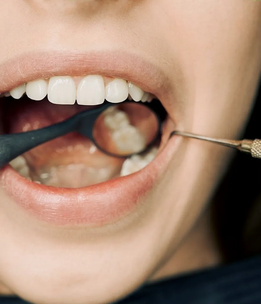Close dental examination and cleaning around the gumline